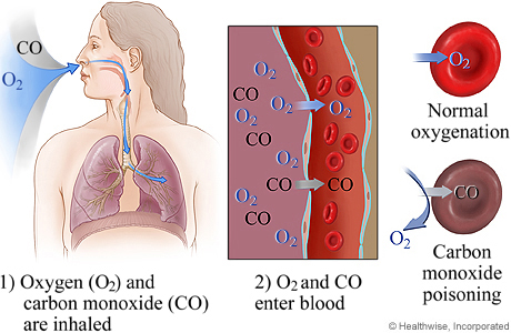 dibujos que muestran cómo la inhalación de monóxido de carbono afecta a la sangre. Dibujo de los pulmones. Acercamiento al efecto en la sangre donde se reemplaza el oxígeno por el monóxido de carbono  